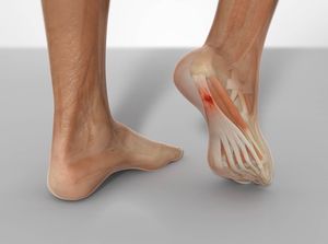 Plantar fasciitis as a condition treatable with chiropractic care